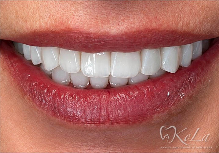 Bright even smile after Invisalign, 12 porcelain veneers and 8 crowns at KoLa Dentistry in Austin, TX