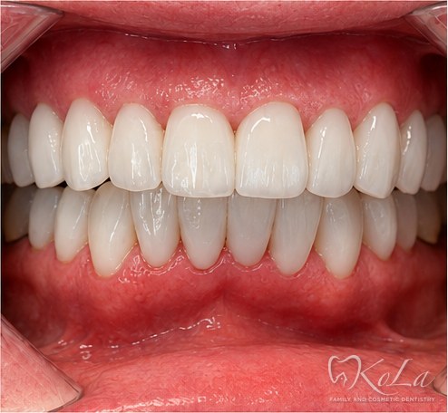 Straight white smile after 8 porcelain crowns and 12 veneers at KoLa Dentistry in Austin