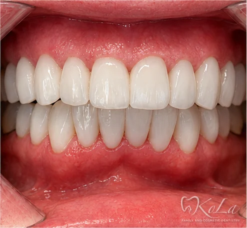 Straight white smile after Invisalign, 12 porcelain veneers and 8 crowns