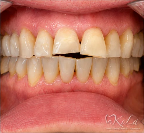 Chipped, worn and discolored front teeth after Invisalign, before porcelain veneers and crowns