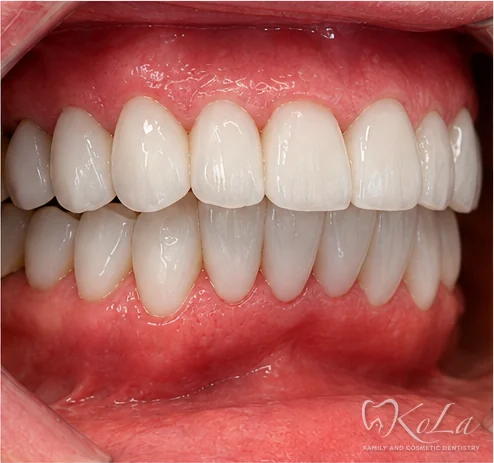 Side view of aligned porcelain veneers and crowns after smile makeover