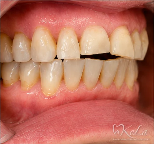 Side view of chipped, worn teeth after Invisalign, before veneers and crowns