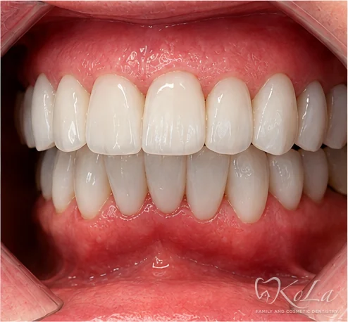 Even bright teeth after porcelain veneers and crowns smile makeover