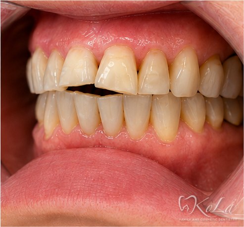 Worn yellowed teeth with broken front tooth after Invisalign, before veneers and crowns