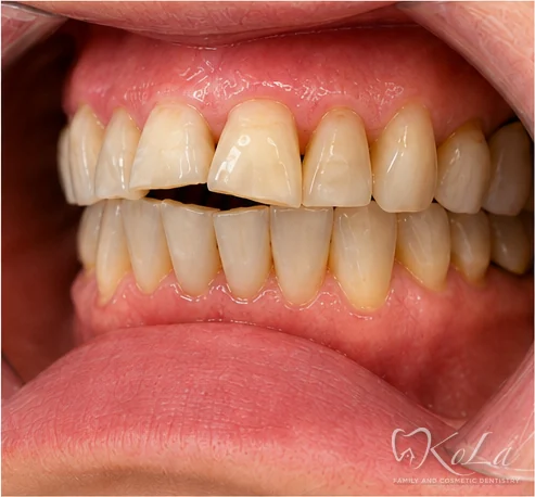 Worn yellowed teeth with broken front tooth after Invisalign, before veneers and crowns