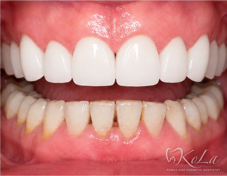 10 upper porcelain veneers with whitened lower teeth at KoLa Dentistry in Austin