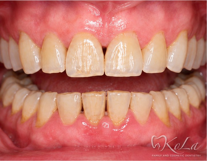 Discolored worn upper teeth before porcelain veneer treatment